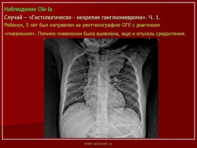 Опухоли средостения: симптомы у взрослых, прогноз, лечение