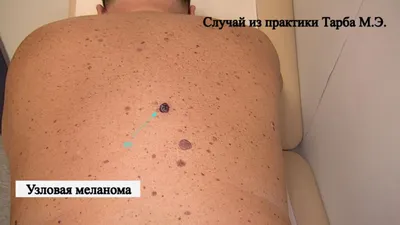 Акне, угревая болезнь – что это, 💉 лечение, симптомы и 🔬 диагностика на  МЕД Zoon