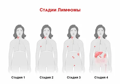 Рак лимфоузлов: Первые симптомы и прогноз с метастазами