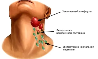 Файл:Lymph node  — Википедия