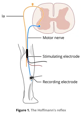 Reflexes, Muscle Tone and Learning: Tonic Labyrinthine Reflex- Blog #5 -  The Big Picture Therapy