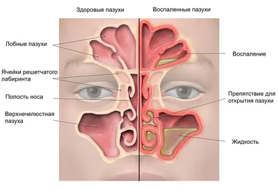 Вазомоторный Ринит что это такое, симптомы и лечение у взрослых