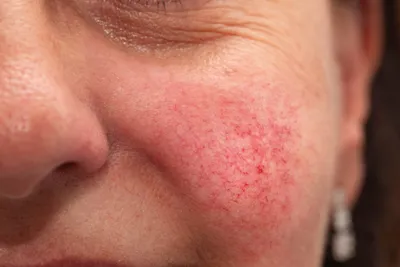 Розацеа - как не пропустить начало заболевания и как ухаживать за кожей с  красными щеками? | Химик про косметику | Дзен