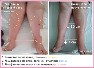 Рожа – что это за болезнь и как ее лечить – бешиха