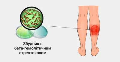 Лучшие мази для лечения рожистого воспаления на ногах и руках: список топ-8  недорогих и эффективных средств для взрослых по версии КП с отзывами и  ценами