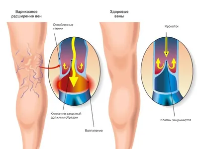 Варикоз на ногах, как избавиться? | Блог Daily Medical