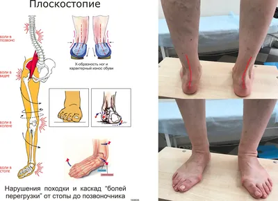 Плоскостопие и варикоз | Доктор Хамидуллин Самара