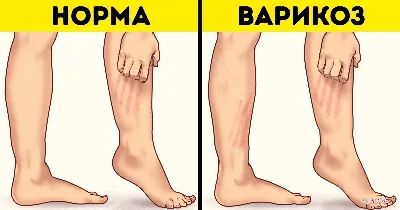 Упражнения и тренировки при варикозе на ногах