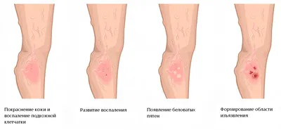Рожистое воспаление симптомы и лечение — Евромедклиник 24