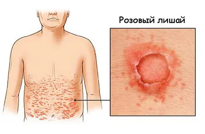 Розовый лишай (лишай Жибера): симптомы, лечение, причины возникновения