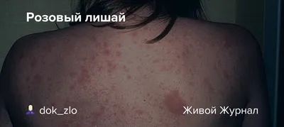 Розовый лишай Жибера: лечение в Brenner Clinic (Киев)