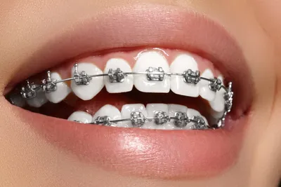 Чистка зубов с брекетами методом Air Flow