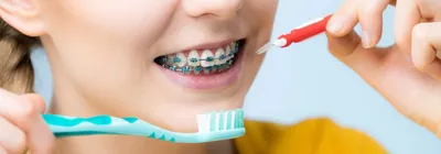 Как ухаживать за брекетами? - DentaDerm