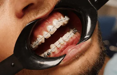 Мифы о брекетах и коррекции прикуса: больно ли, кому подходят, расшатывают  ли зубы