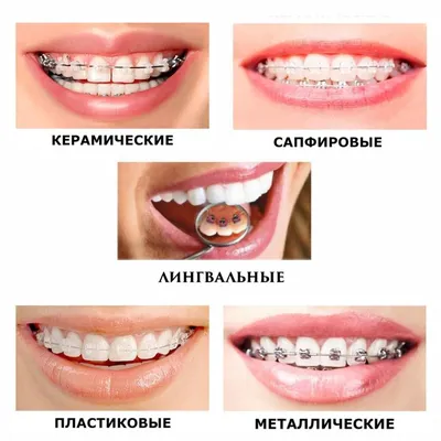 Болезненность зубов при брекетах - Сколько болят зубы после установки  брекетов