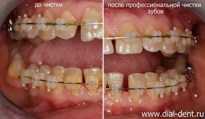 Чистка зубов с брекетами