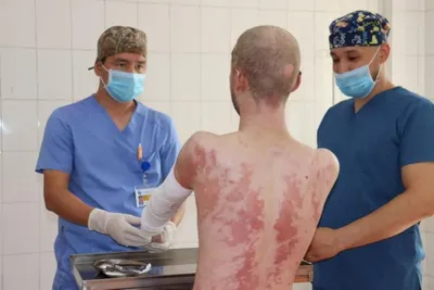 Абсолютный рекорд установили алматинские врачи: спасли пациента с 94%  ожогом тела