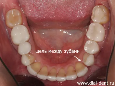 Закрытие щели между зубами капами 3D Smile