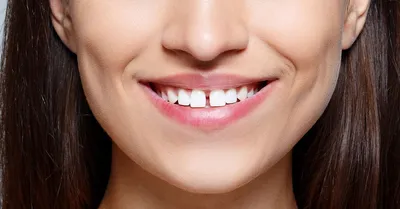 Щель между зубами (диастема): 8 способов лечения, как убрать щель между  передними верхними зубами в стоматологии