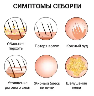 Лечение себореи волосистой части головы – Публикации – Лаборатория Ан-Тек