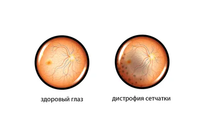 Коагуляция сетчатки, укрепление сетчатки в Визус-1