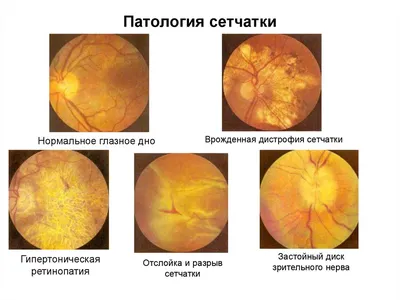 Отслоение сетчатки глаза: что это такое и чем опасно? «»