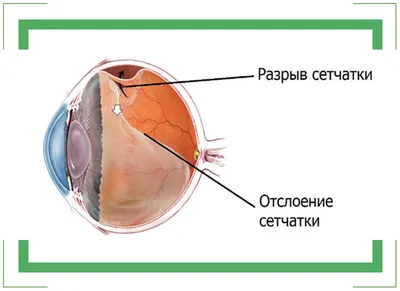 Лечение отслойки сетчатки глаза хирургическими операциями