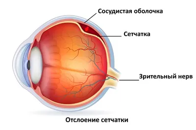 Отслоение сетчатки глаза - симптомы, причины, лечение с помощью операции и  профилактика