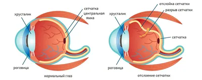 Лечение патологии сетчатки. Компания АртОптика г. Челябинск