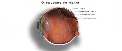 Лечение сетчатки глаза