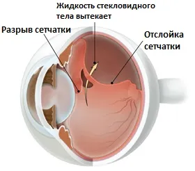 Лечение сетчатки глаза (дистрофия сетчатки глаза, отслоение сетчатки)