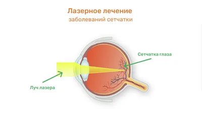 Лечение заболеваний сетчатки глаза в Санкт-Петербурге - цены в клинике  «Счастливый Взгляд»