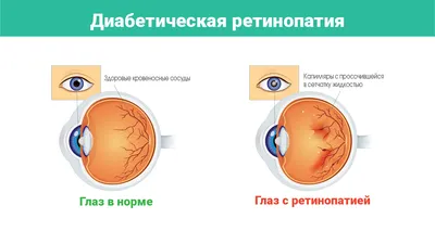 Лечение ожога сетчатки глаза по доступным ценам в Наро-Фоминске