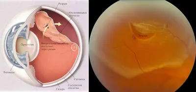 💙 󾬓 Лечение разрыва сетчатки глаза 💙 󾬓 Операции при газрыве сетчтки в  ЗОКБ