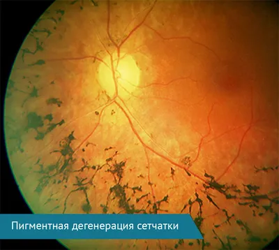 Дистрофия сетчатки глаза - симптомы дистрофии глаза, виды, классификация
