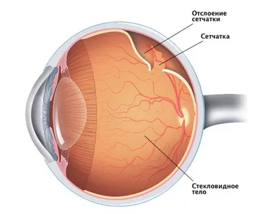 Отслоение сетчатки глаза: симптомы, причины, лечение, классификация  паталогии