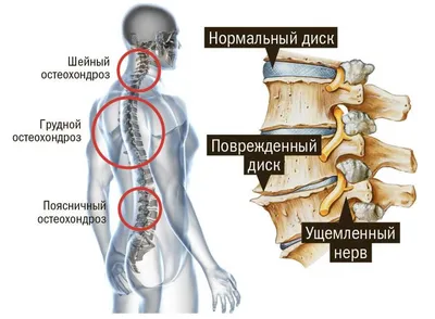 Главное о шейном остеохондрозе. Профилактика. Лечение