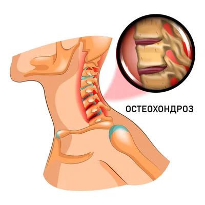 Шейный остеохондроз ✔️: симптомы, признаки и лечение остеохондроза шейного  отдела