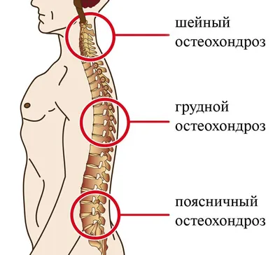 Лечение остеохондроза | МЦ "Эс Клиник" Астрахань