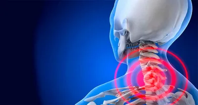 Шейный остеохондроз: симптомы, причины и лечение в Набережных Челнах