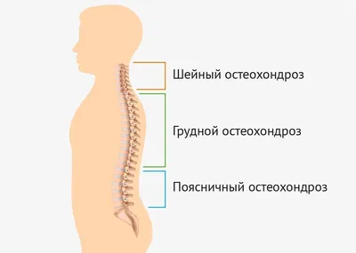 Лечение остеохондроза позвоночника в домашних условиях | Солнышко