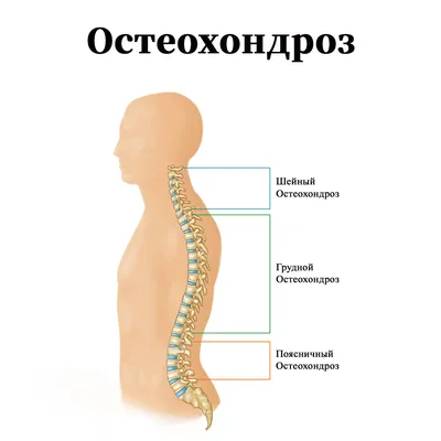 Остеохондроз лечение в клинике VERTEBRA | Киев