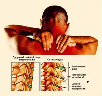 НАЗДОРОВЬЕ: шейный остеохондроз - YouTube