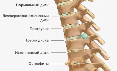 Остеохондроз: шейный, грудной, поясничный, симптомы, лечение