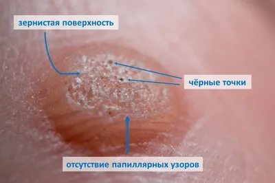 Удаление подошвенных бородавок Шипица лазером в Москве в Клинике МиДерм