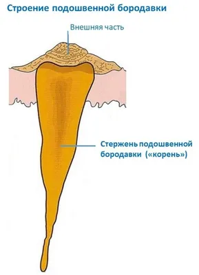 Лечение и удаление мозолей на ногах | Подолог в Алматы