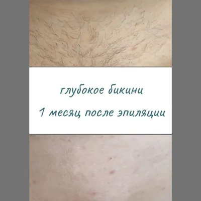 Шугаринг бикини классика в Запорожье, в салоне красоты Sweet Body, Приятные  Цены