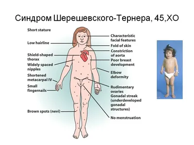 Синдром Эдвардса? при хорошем УЗИ 1 скрининга. — 17 ответов | форум Babyblog