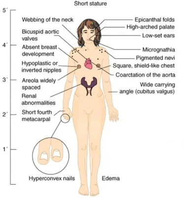 Синдром Эдвардса? при хорошем УЗИ 1 скрининга. — 17 ответов | форум Babyblog