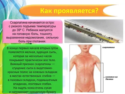 ПРОФИЛАКТИКА СКАРЛАТИНЫ – МБОУ Удомельская гимназия №3 им. О.Г. Макарова